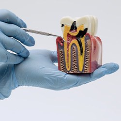 Gloved hands holding model of an infected tooth