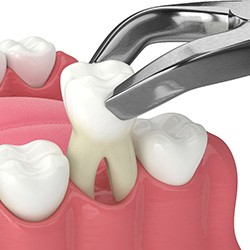 Illustration of tooth being removed with forceps