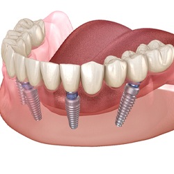 four dental implants in Sagamore Hills supporting a full denture