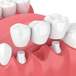 Illustration of dental bridge in Sagamore Hills