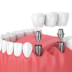 Illustration of implant bridge in Sagamore Hills