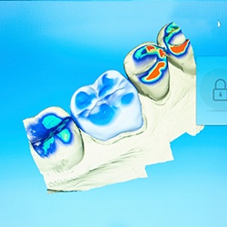 CEREC smile design software