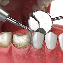 Illustration of plaque being removed in teeth cleaning
