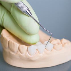 Dental Bridge