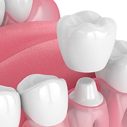 Illustration of dental crown in Sagamore Hills being placed