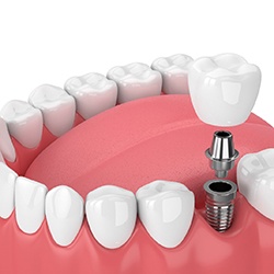 dental implant being placed in the lower jaw 