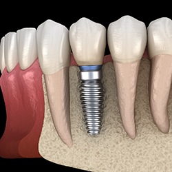 dental implant in the jawbone 