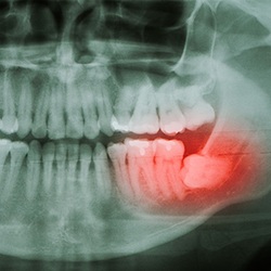 an X-ray depicting an impacted and painful tooth