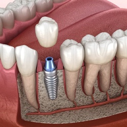 single dental implant with a crown