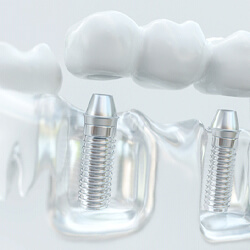 3D model of an implant-retained bridge