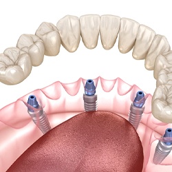 Four dental implants in Sagamore Hills and denture