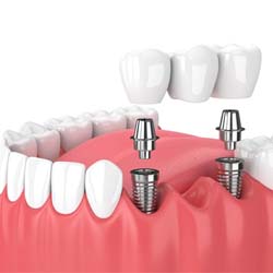 two dental implants supporting a dental bridge