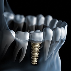 Animation of implant supported dental crown