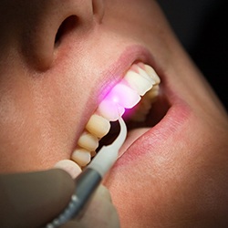 Close-up of patient’s mouth during laser periodontal treatment