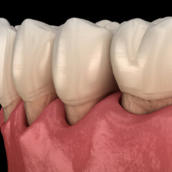 Digital image of gum recession