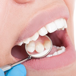 Closeup of smile during dental exam