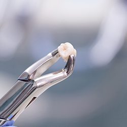 Metal clasps holding extracted tooth