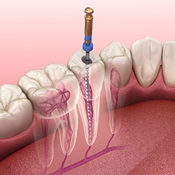 Illustration of root canal treatment in Sagamore Hills, OH