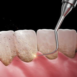 Illustration of plaque being removed during scaling and root planing