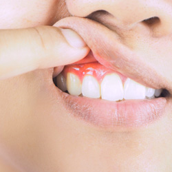 Pulling up lip to show inflamed gums