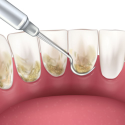 Illustration of scaling and root planing being performed on back of teeth