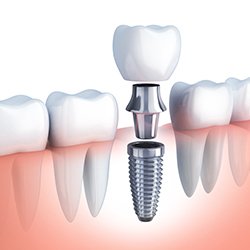 Animation of implant supported dental crown