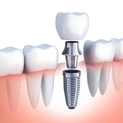 Animation of implant supported dental crown