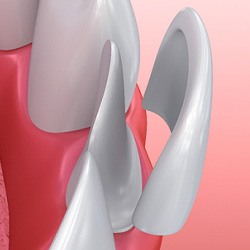 illustration of veneer being placed on tooth in lower arch