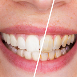 before and after teeth whitening