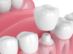 Illustration of a dental crown being placed on a tooth