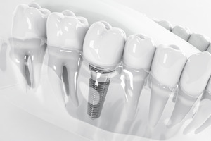 Render of dental implant in model of jawbone