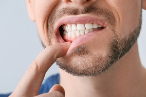 Man pulling down lip to show swollen gums