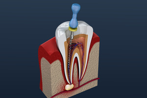 Illustration of root canal treatment